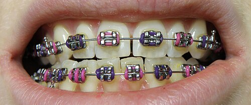 Orthodontic wire