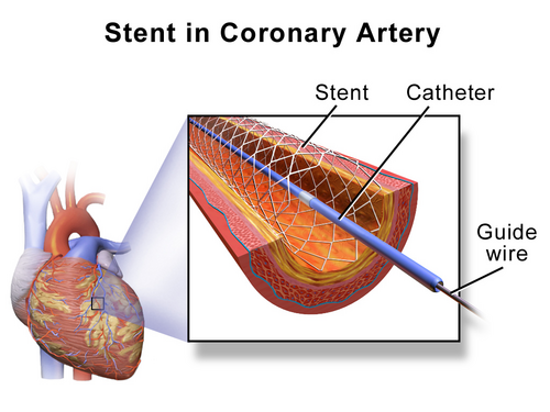 Self-expanding stent
