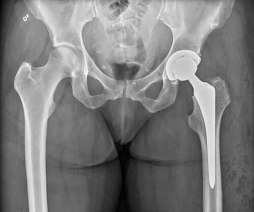 Hip implant stem