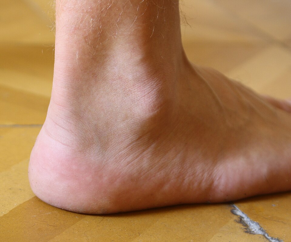 Diagram of the ankle joint showing bones and ligaments